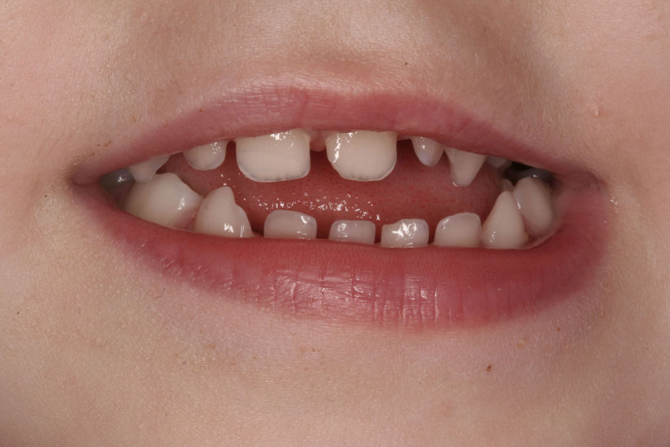 Troubles du spectre autistique : regardez les dents...