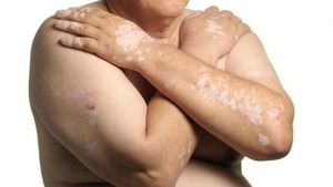 Vitiligo sous traitement au pembrolizumab : un facteur de bon pronostic ?