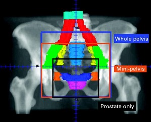 Radiothérapie pour cancer de la prostate. Risque accru de cancer de la vessie et de cancer colorectal