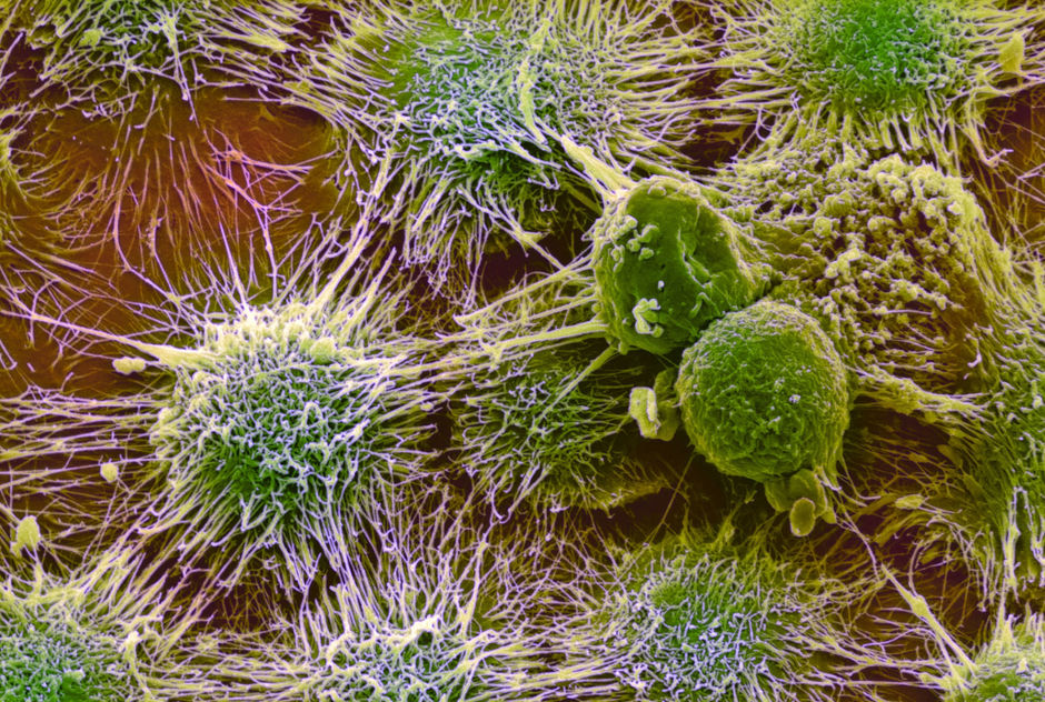 Traitement du cancer du rein : premières guidelines centrées sur l'immunothérapie