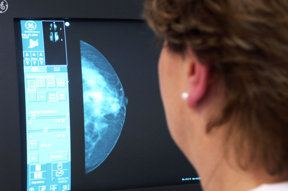 Cancer du sein avec tissu mammaire dense. Risque de développer une maladie controlatérale