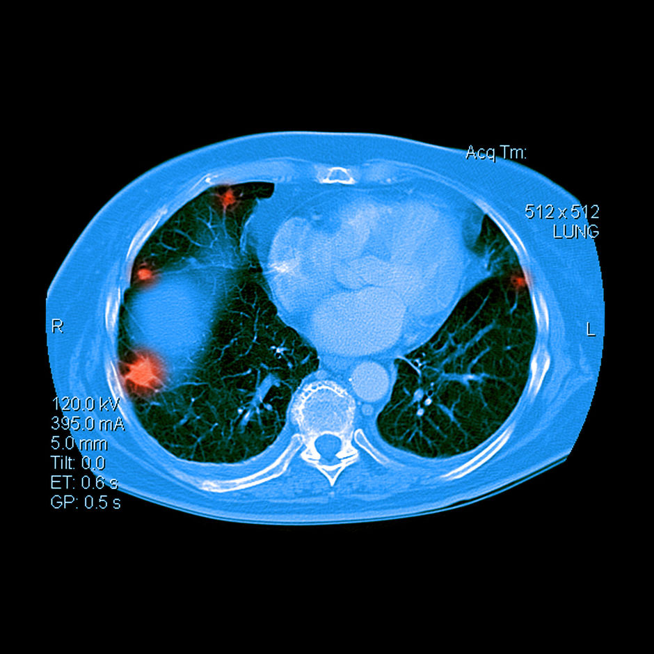 Le dépistage du cancer du poumon est trop fréquent chez les femmes