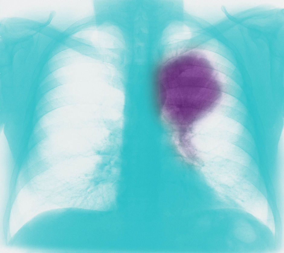 Le traitement d'oligométastases pulmonaires en cas de NSCLC