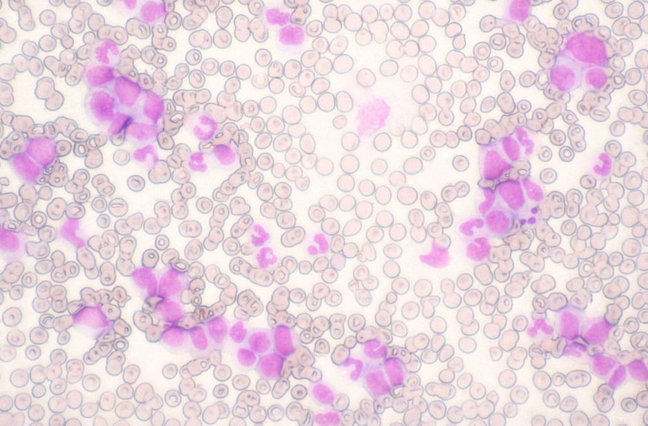 Hématopoïèse clonale chez les patients atteints de cancers non hématologiques