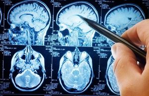 L'intelligence artificielle permet de détecter plus tôt l'Alzheimer