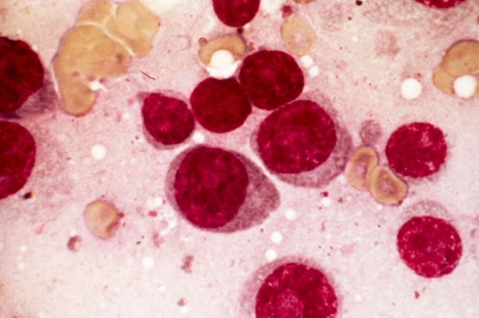 Carfilzomib vs bortezomib dans le myélome multiple récidivant ou réfractaire