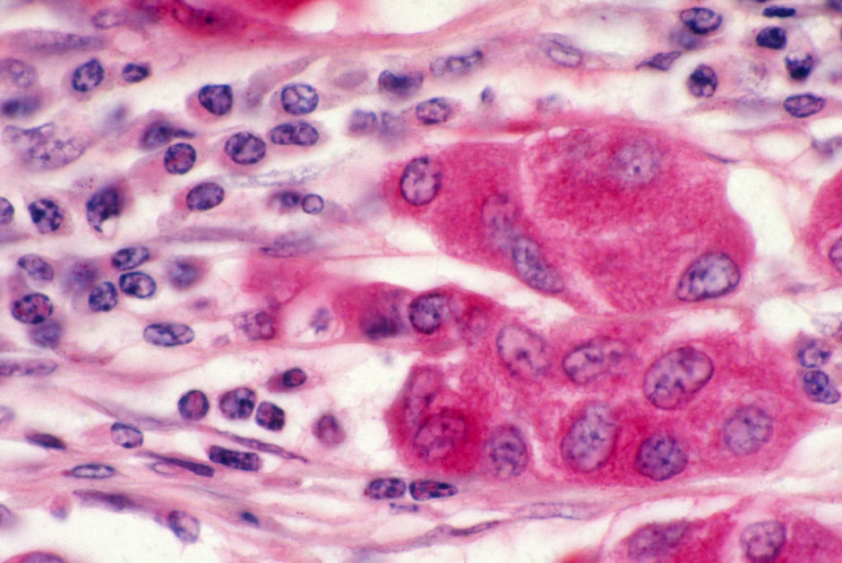 Taux des TILs et pronostic dans les sous-types de cancer du sein