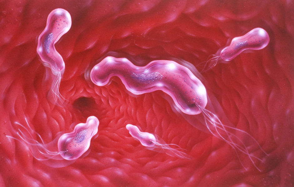 Saignements iatrogènes des ulcères gastro-duodénaux, rôle d'H. pylori