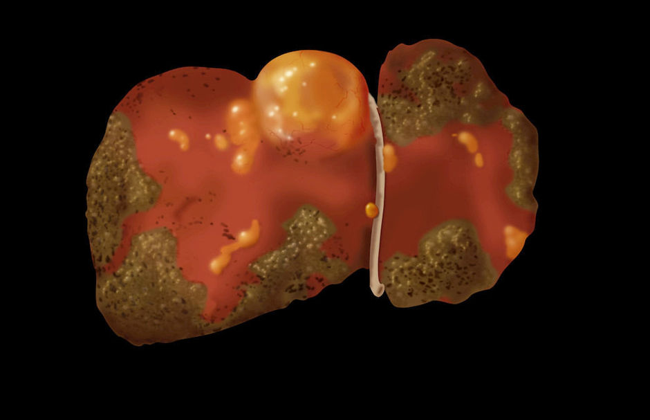 Radioembolisation vs Sorafénib dans le carcinome hépatocellulaire