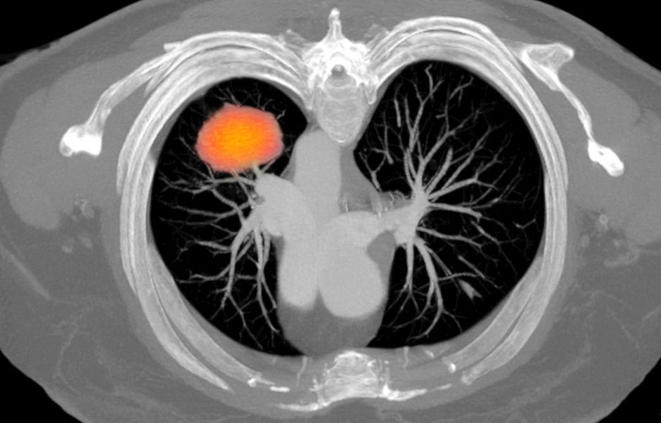 Ajout du pembrolizumab à la chimiothérapie dans le NSCLC métastatique