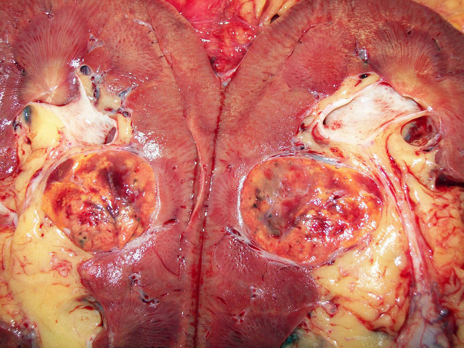 Sunitinib vs néphrectomie suivie de sunitinib dans le RCC métastatique