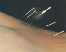 L'acupuncture soulage la sécheresse de bouche due à la radiothérapie pour un cancer tête-cou