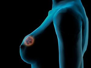 Traitement du cancer du sein dans 10 ans: les prédictions d'un expert