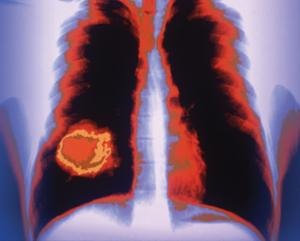 Les fumeurs porteurs d'une mutation BRCA2 ont un risque accru de développer un cancer du poumon