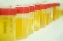 Des protéines urinaires peuvent aider à détecter le cancer du rein