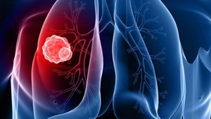 Un CT annuel à faible dose dépiste les nodules pulmonaires précancéreux