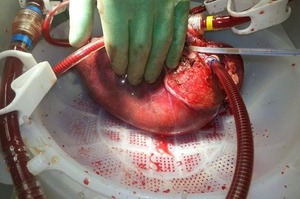 Transplantation hépatique dans les cancers du foie de l'enfant