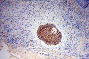 Priver les cellules cancéreuses de cholestérol inhibe la croissance tumorale et améliorer la sensibilité aux drogues