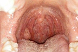 La plupart des récidives des cancers oropharyngés HPV+ diagnostiquées dans les 6 mois