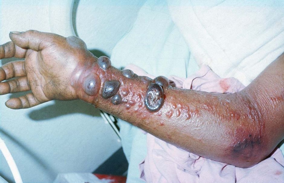 L'éradicateur de la variole est mort